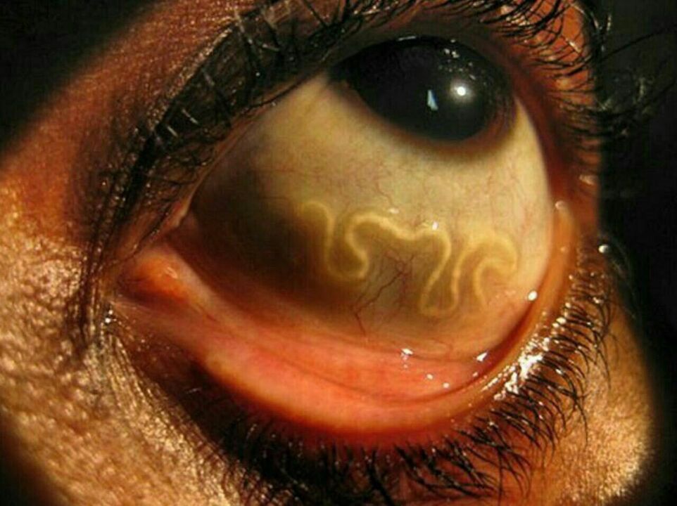 parasitos no ollo humano